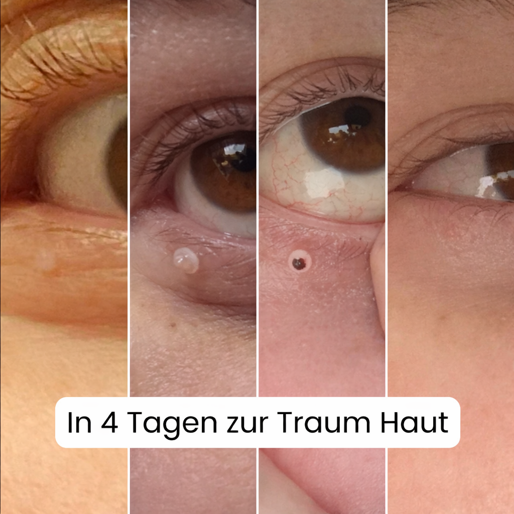 ALCURA™ - Glatte Haut in wenigen Tagen