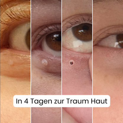 ALCURA™ - Glatte Haut in wenigen Tagen