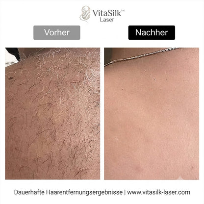 VitaSilk™ Laser