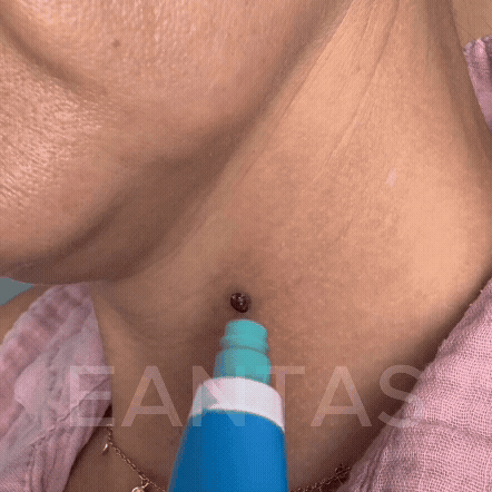 ALCURA™ - Glatte Haut in wenigen Tagen