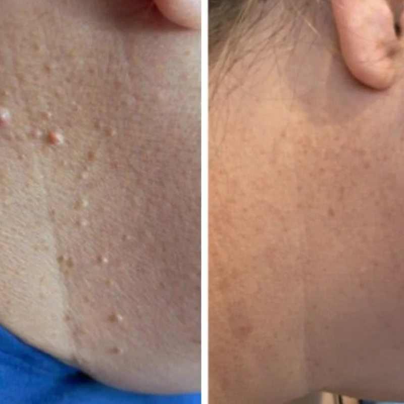 ALCURA™ - Glatte Haut in wenigen Tagen