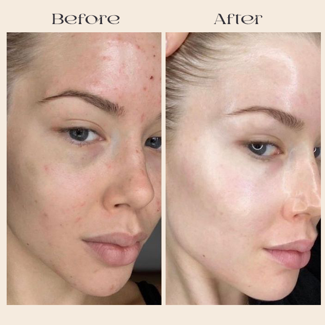 Prandest Arbutin 7% + Tranexamic Acid 4% Cream