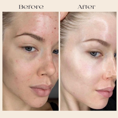 Prandest Arbutin 7% + Tranexamic Acid 4% Cream