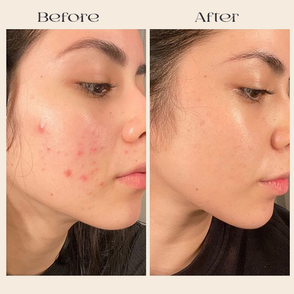 Prandest Arbutin 7% + Tranexamic Acid 4% Cream