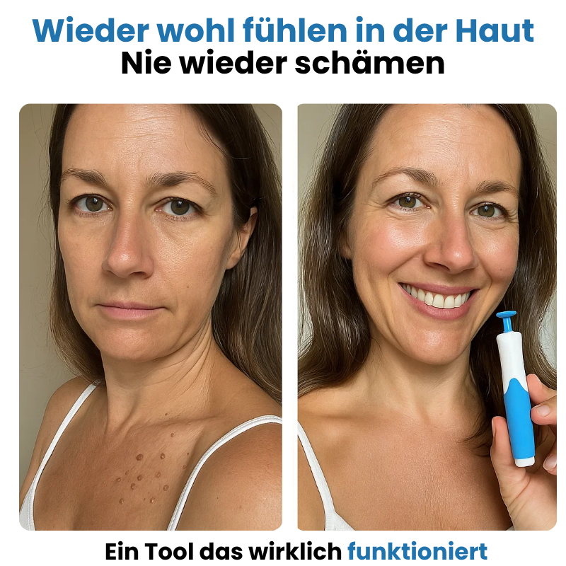 ALCURA™ - Glatte Haut in wenigen Tagen